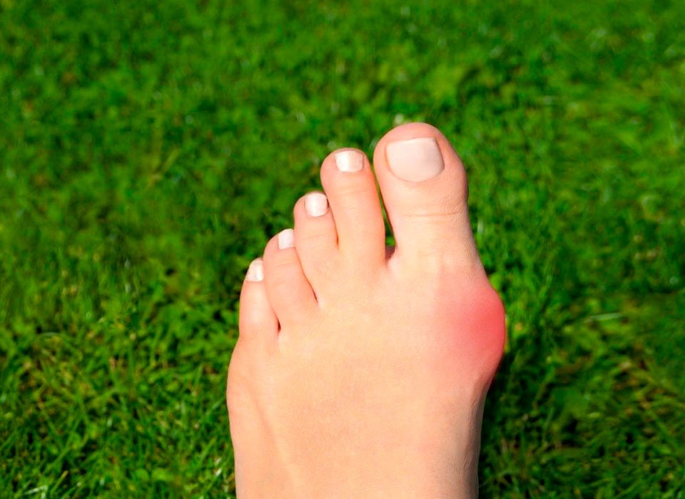 Hallux Valgus durch Übung vorbeugen