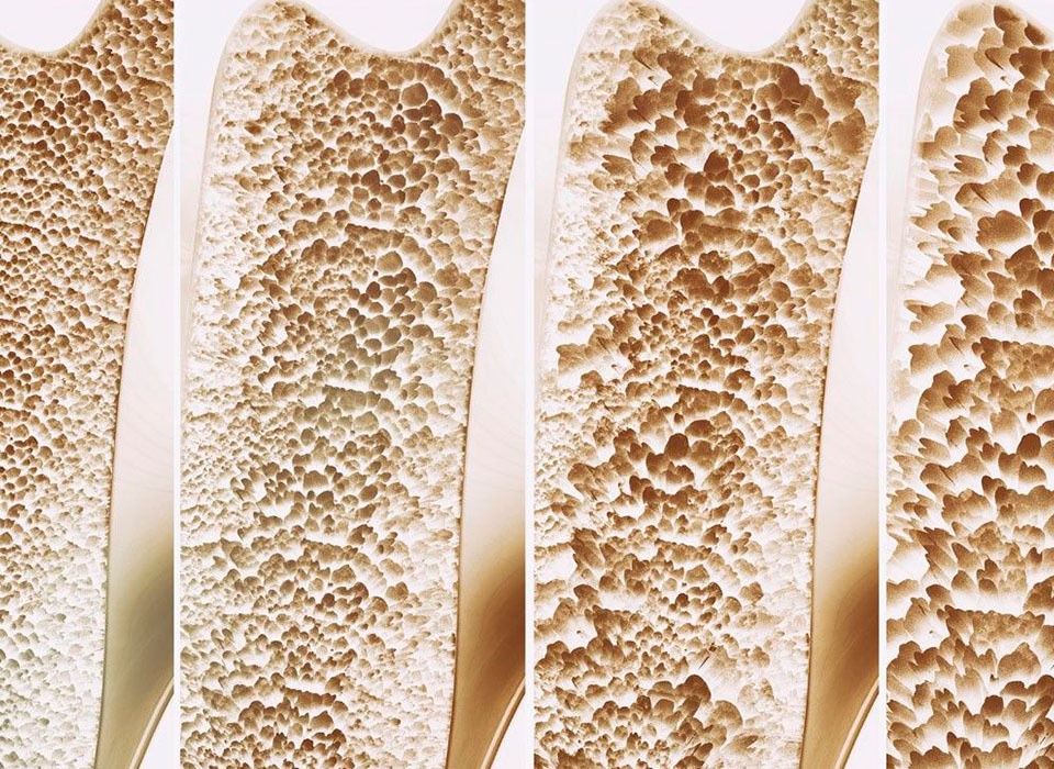 Osteoporose-Symptome erkennen