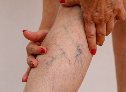 Thrombose 