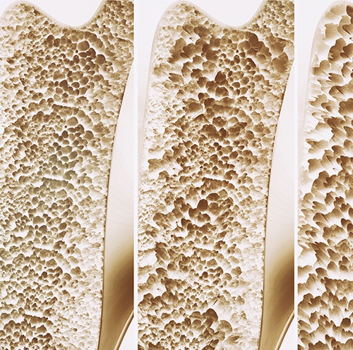 Osteoporose 