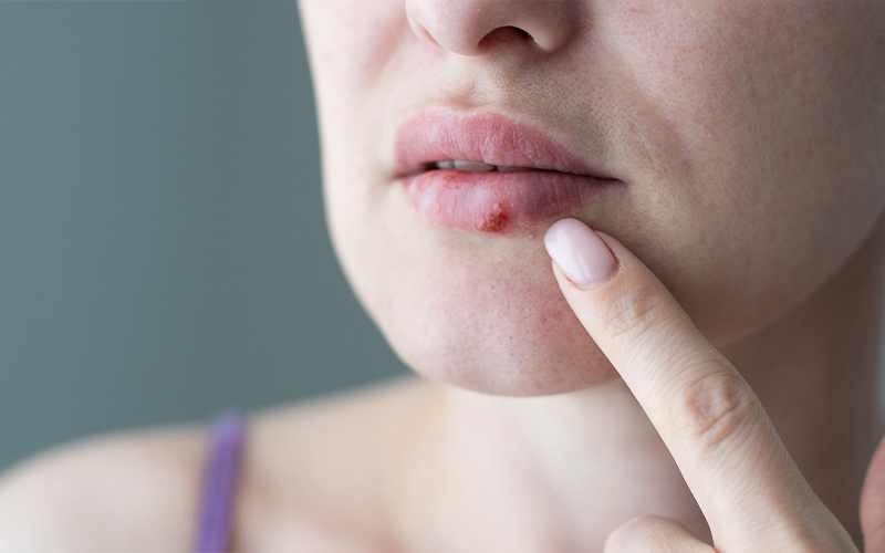 Lippenherpes erkennen