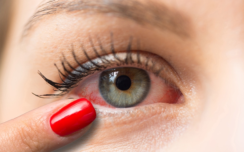 Gerötete Augen bei einer Bindehautentzündung